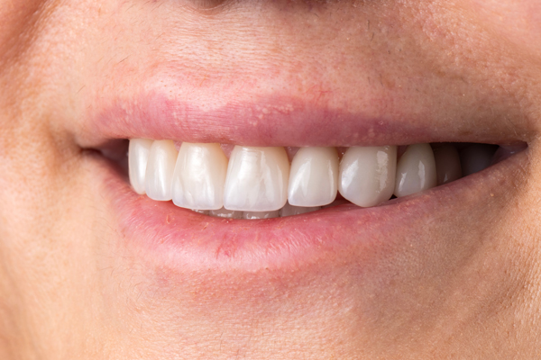 Types Of Dental Crowns: Which One Is Right For You?