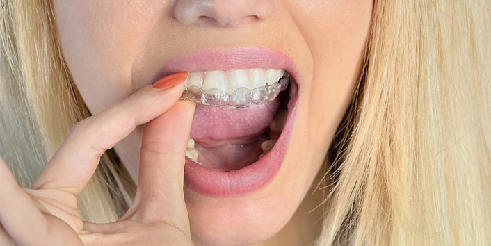 invisalign-ad-phillymag - Philly Dentistry